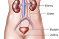 Kidney Diseases Symptoms and Treatment