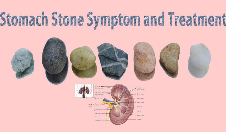 stomach stone symptom and treatment